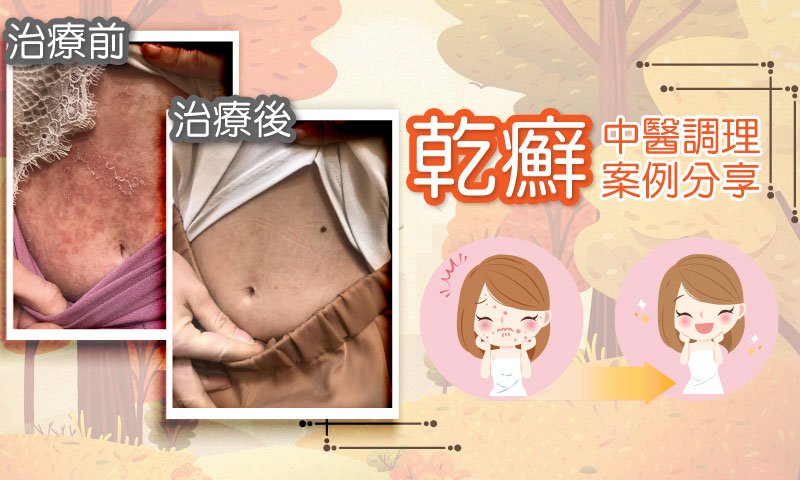 1091029-乾癬案分 1091029-乾癬案分