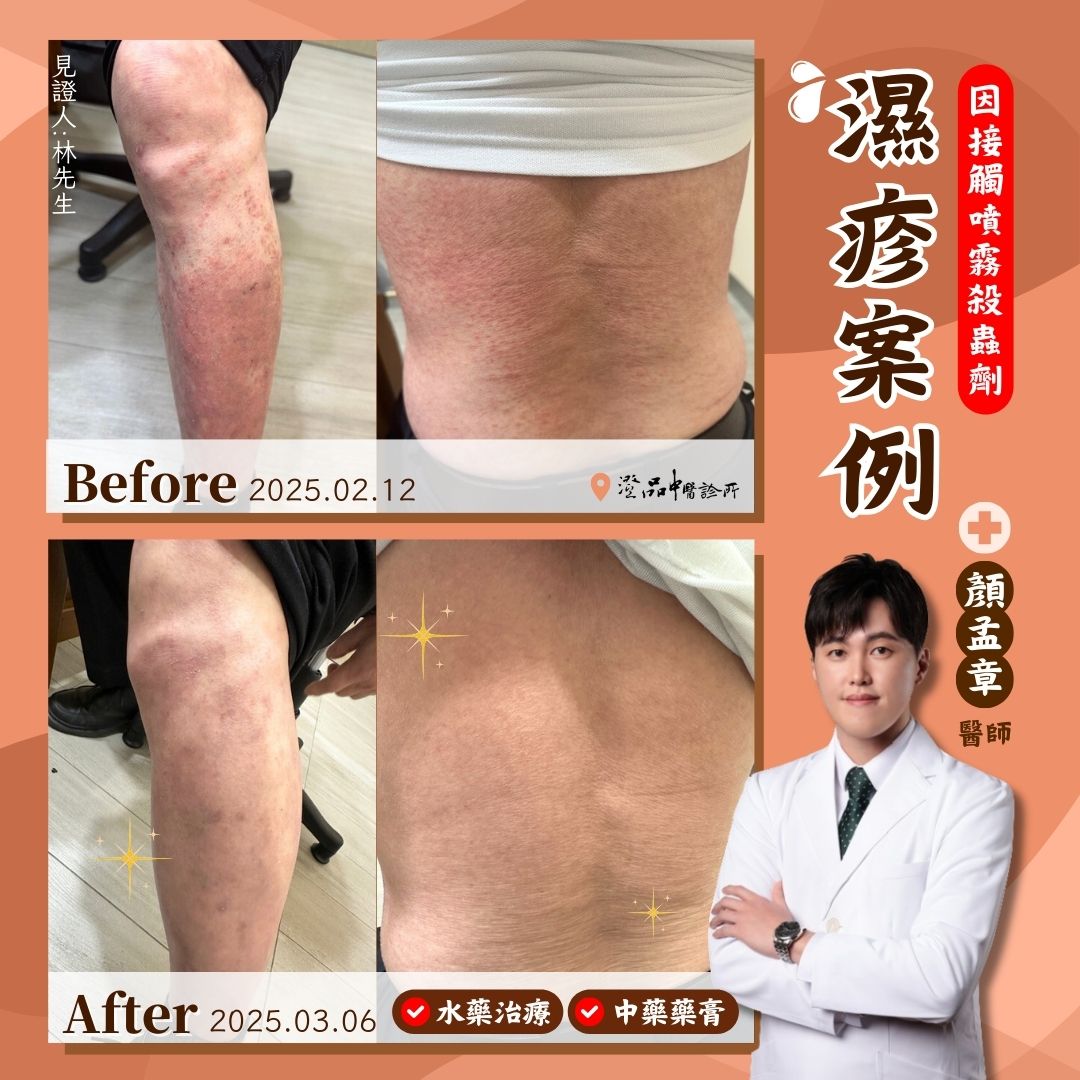 250411_eczema_case 250411_eczema_case