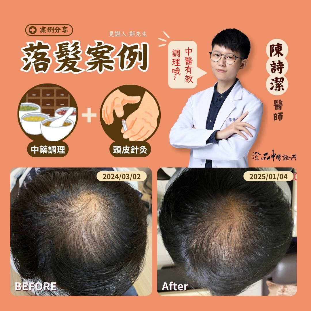 250314_drcsj_HairLoss_case 250314_drcsj_HairLoss_case